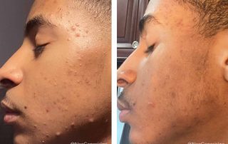 Before + After - Acne