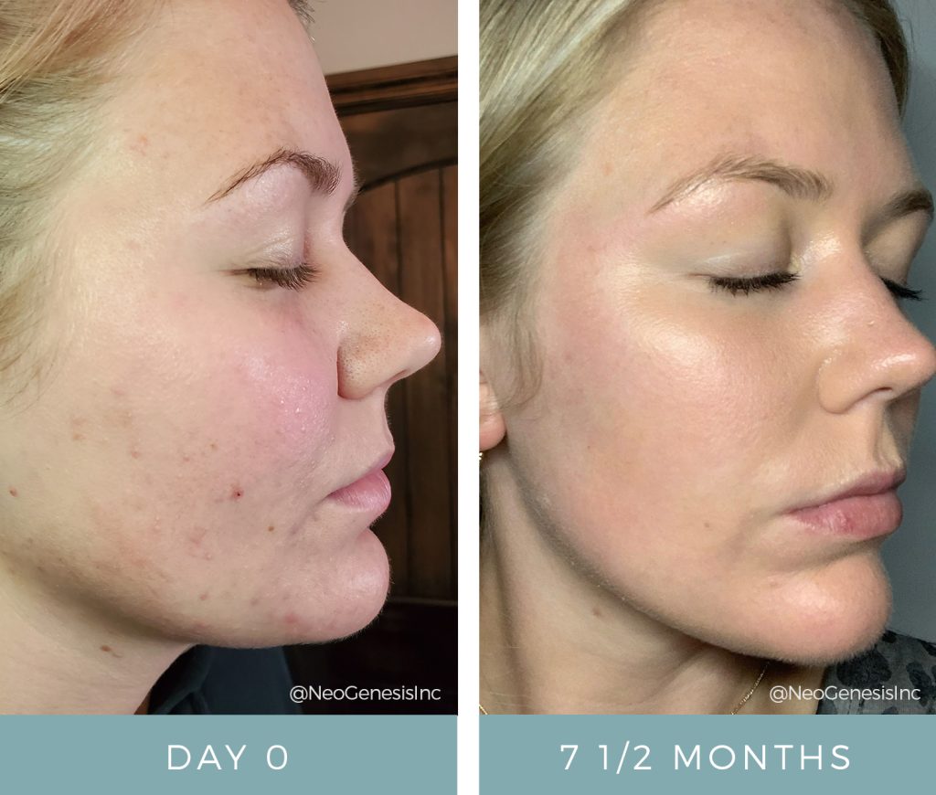 Before + After - Acne