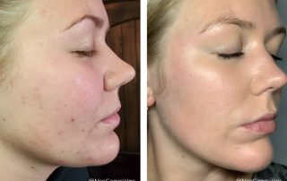 Before + After - Acne