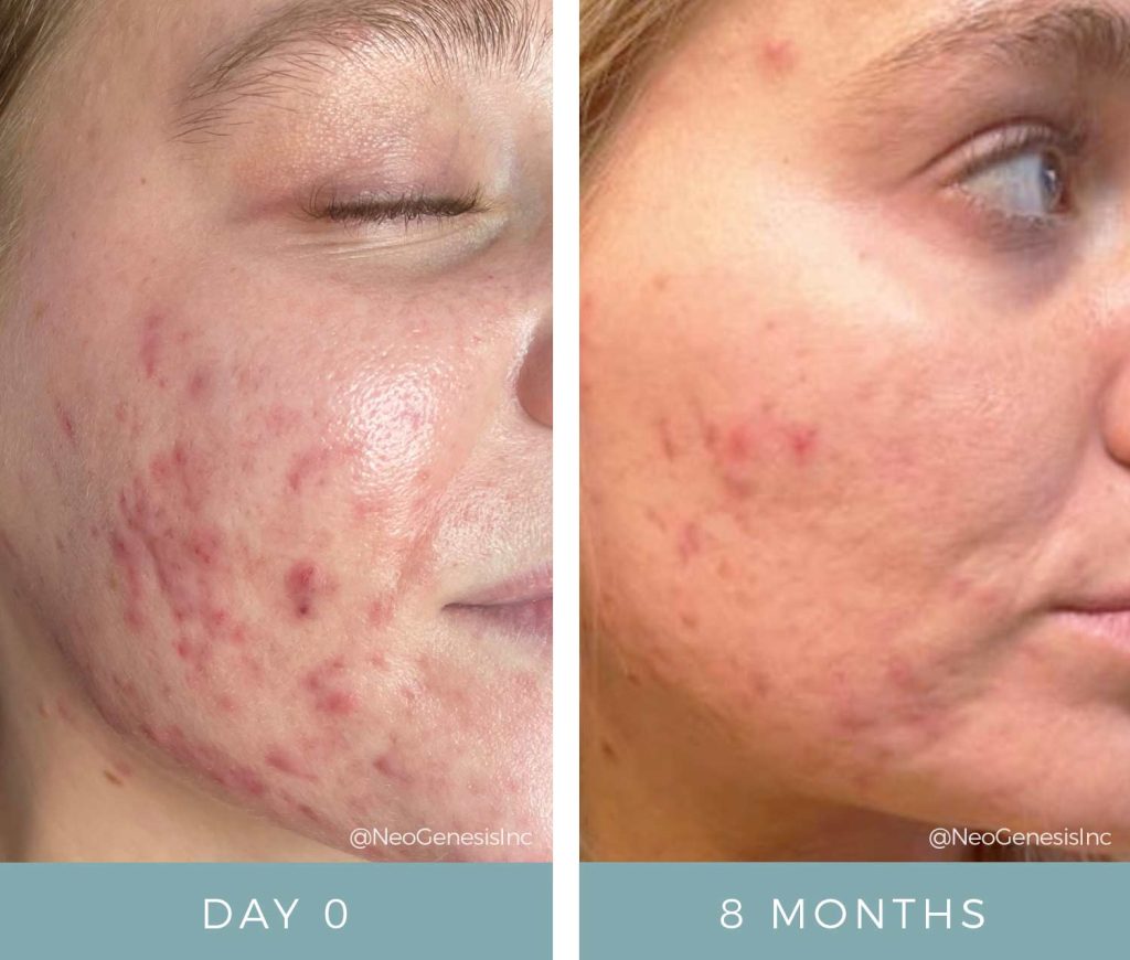 Before + After - Hormonal Acne