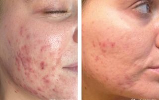 Before + After - Hormonal Acne