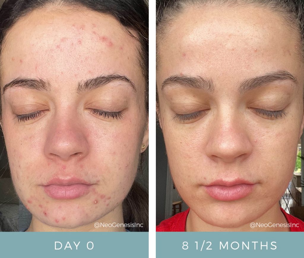 Before + After - Hormonal Acne Breakouts