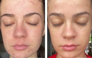 Before + After - Hormonal Acne Breakouts