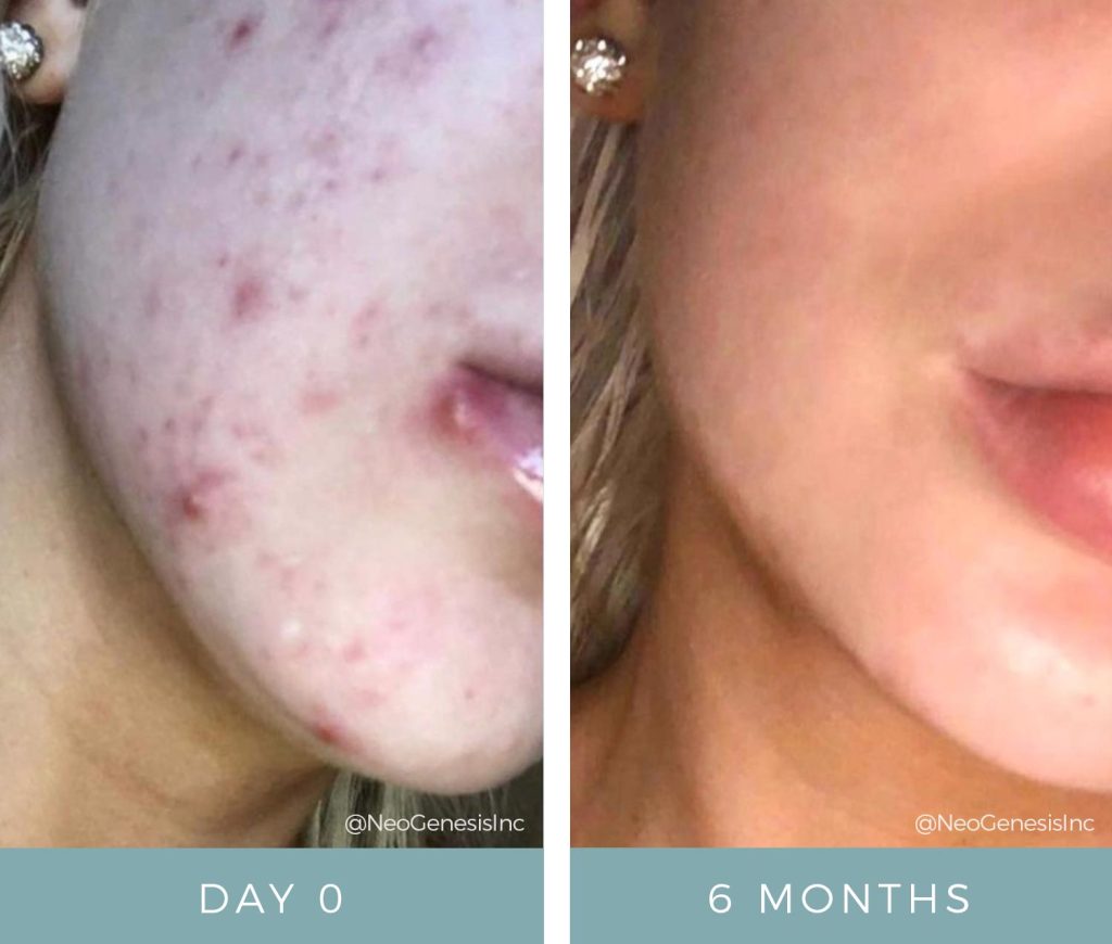 Before + After - Acne