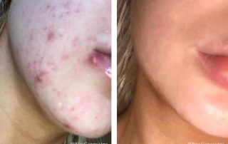 Before + After - Acne