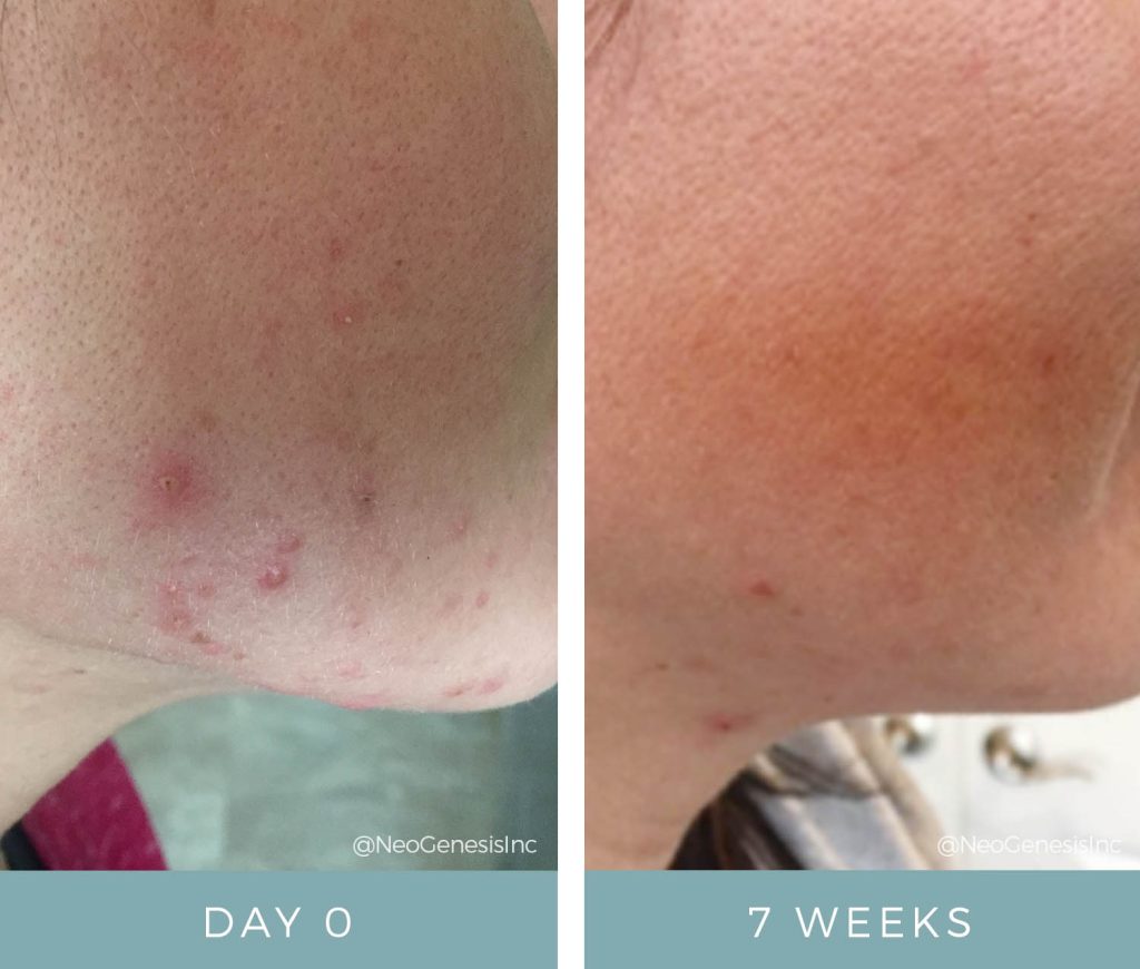 Before + After - Acne