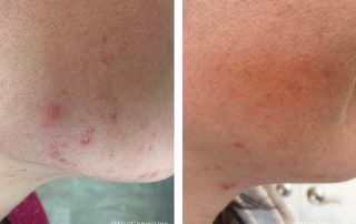 Before + After - Acne