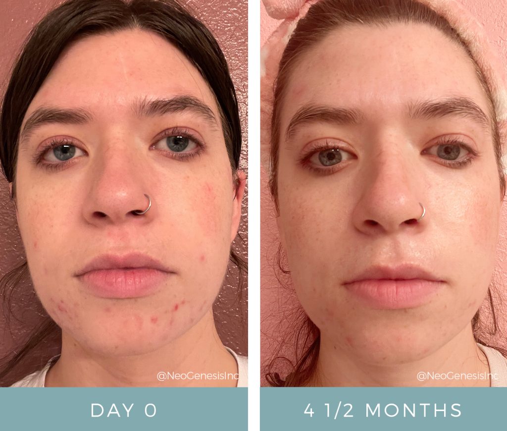 Before + After - Cystic Acne + Sensitive Skin + Maskne