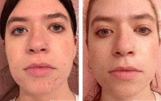 Before + After - Cystic Acne + Sensitive Skin + Maskne