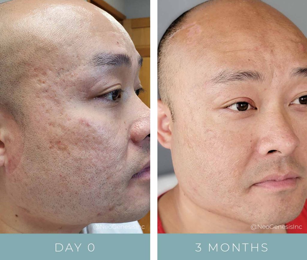 Before + After - Acne Scarring + Microneedling