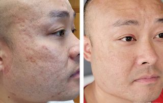 Before + After - Acne Scarring + Microneedling