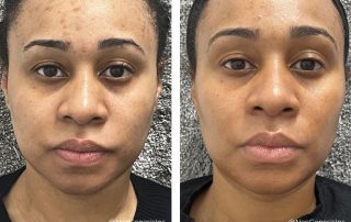 Before + After - Acne and Acne Scarring