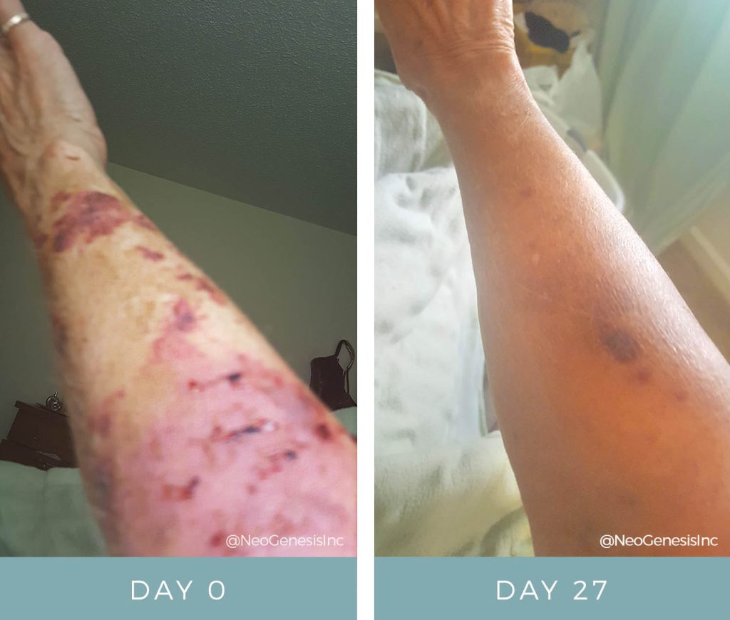 Before + After - Actinic Purpura