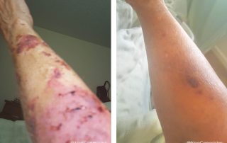 Before + After - Actinic Purpura