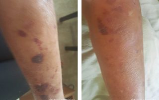 Before + After - Actinic Purpura