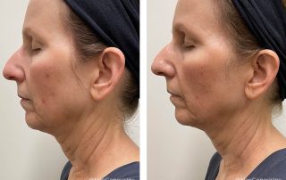 Before + After - Aging Skin