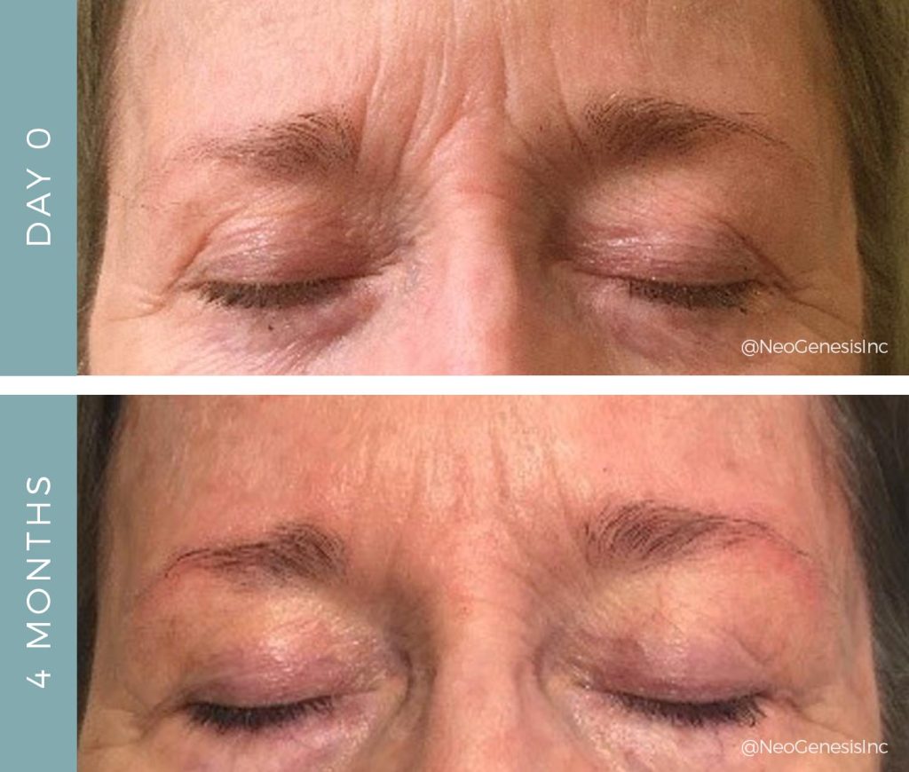 Before + After - Ageing Skin - Eyes