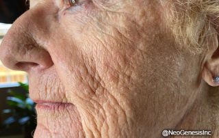 Before - Ageing Skin + Microcurrent