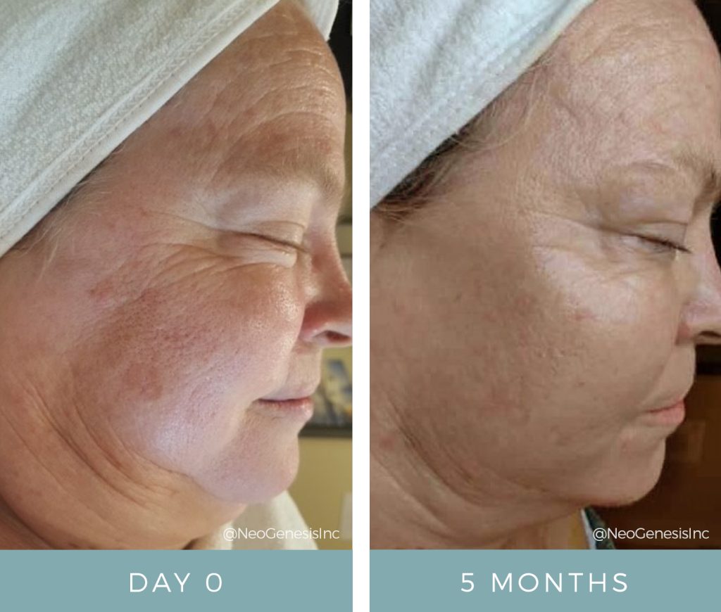 Before + After - Ageing Skin + Hyperpigmentation