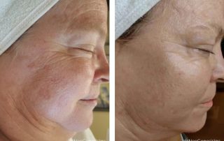 Before + After - Ageing Skin + Hyperpigmentation