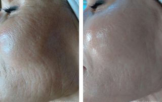 Before + After - Ageing Skin