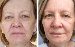 Before + After - Ageing Skin