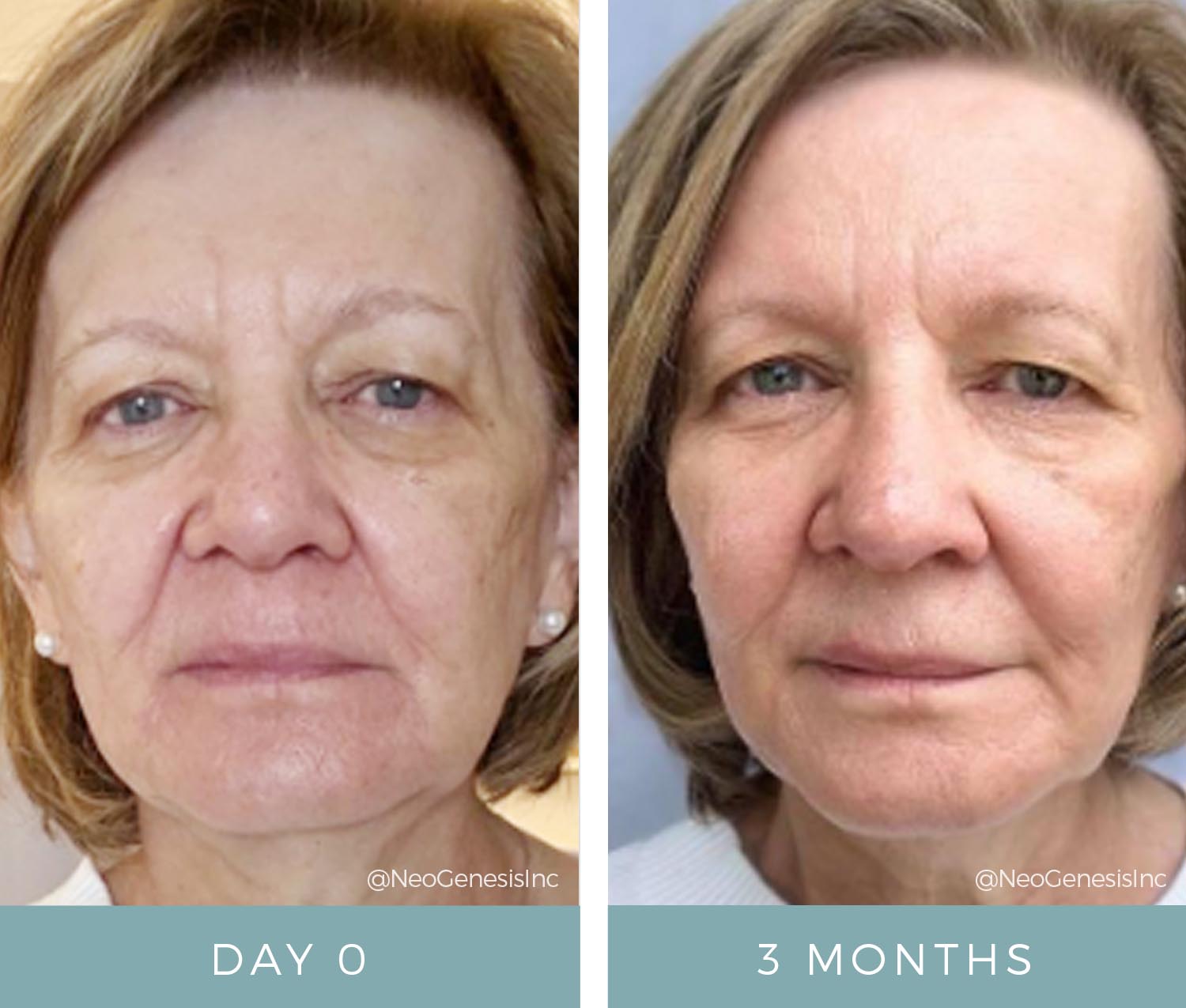 Before + After - Ageing Skin