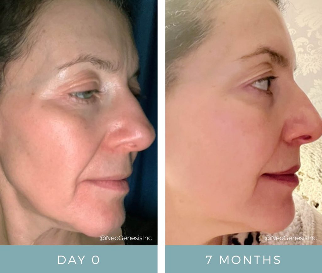 Before + After - Ageing Skin + Rosacea + Eczema