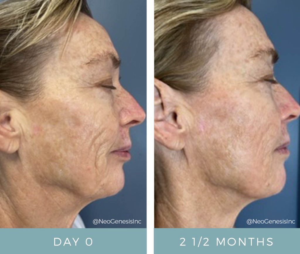 Before + After - Ageing, PIH, Melasma, Sun Damage, Skin Cancer