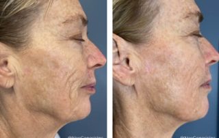 Before + After - Ageing, PIH, Melasma, Sun Damage, Skin Cancer