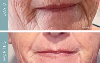 Before + After - Ageing Skin