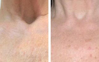 Before + After - Ageing Neck