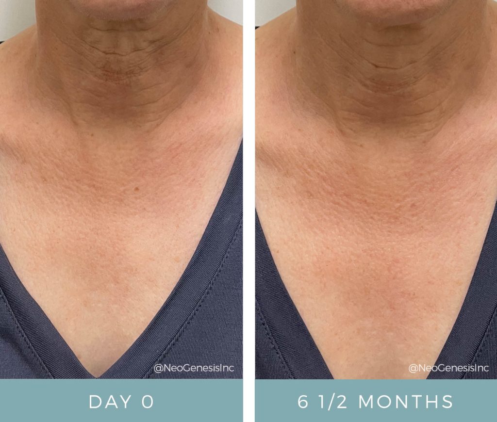 Before + After - Ageing Skin - Neck