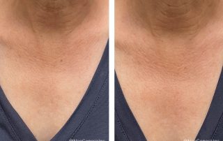 Before + After - Ageing Skin - Neck