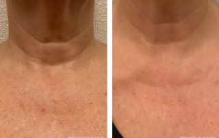 Before + After - Ageing Neck