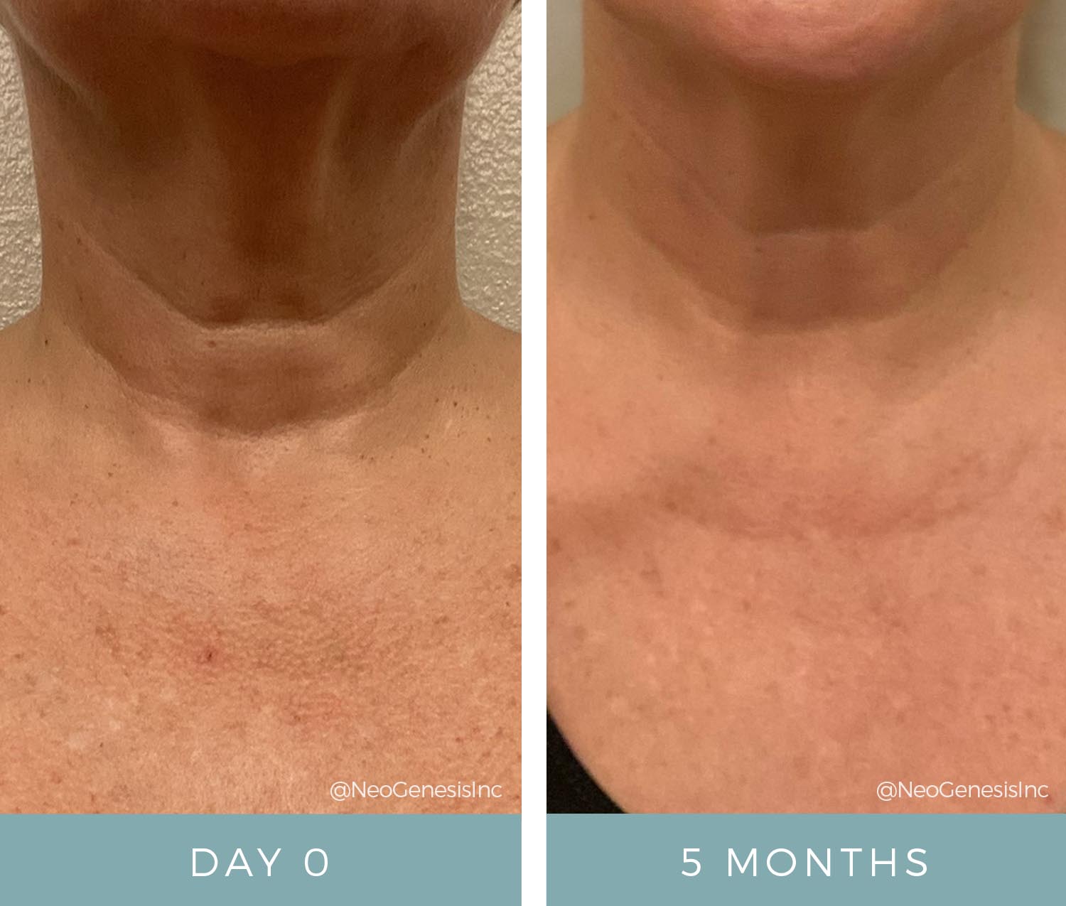 Before + After - Ageing Neck