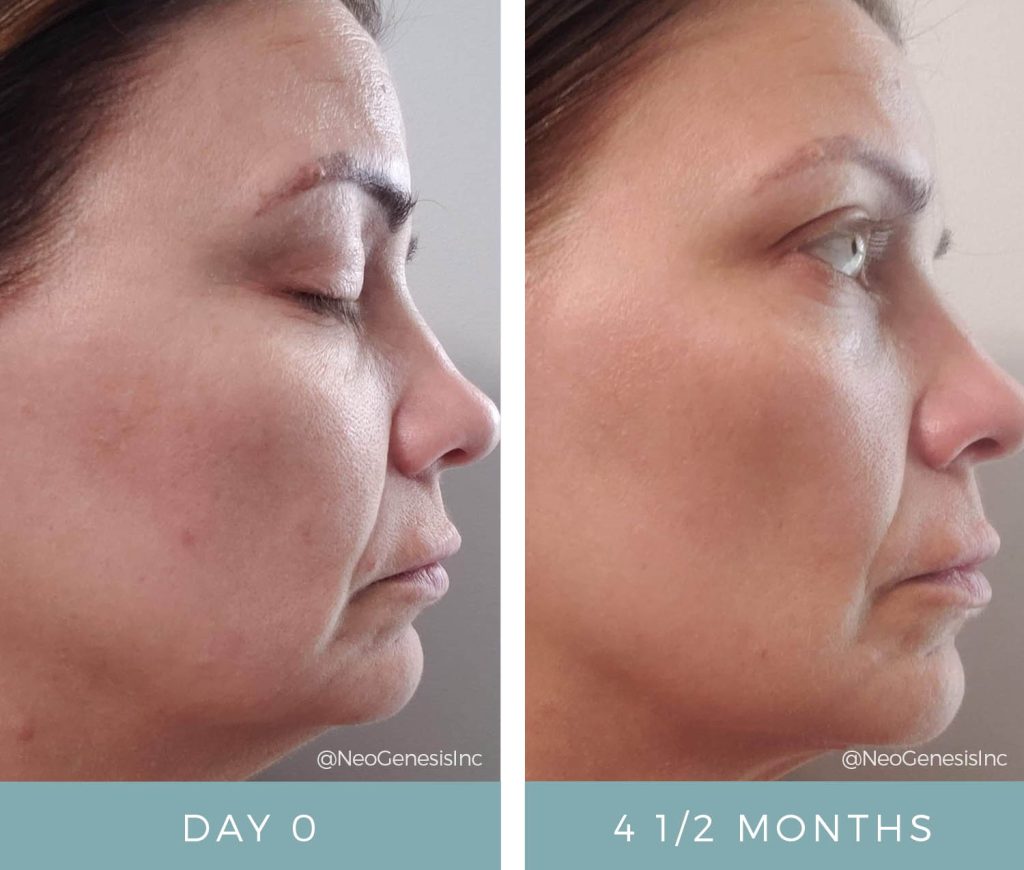 Before + After - Early Signs of Ageing