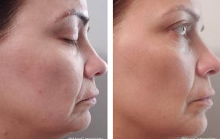 Before + After - Early Signs of Ageing