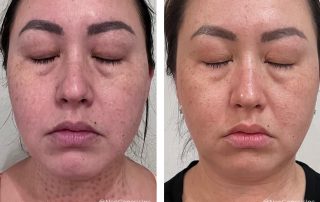 Before + After - Fibroblast Scarring + Ageing Skin + Hyperpigmentation