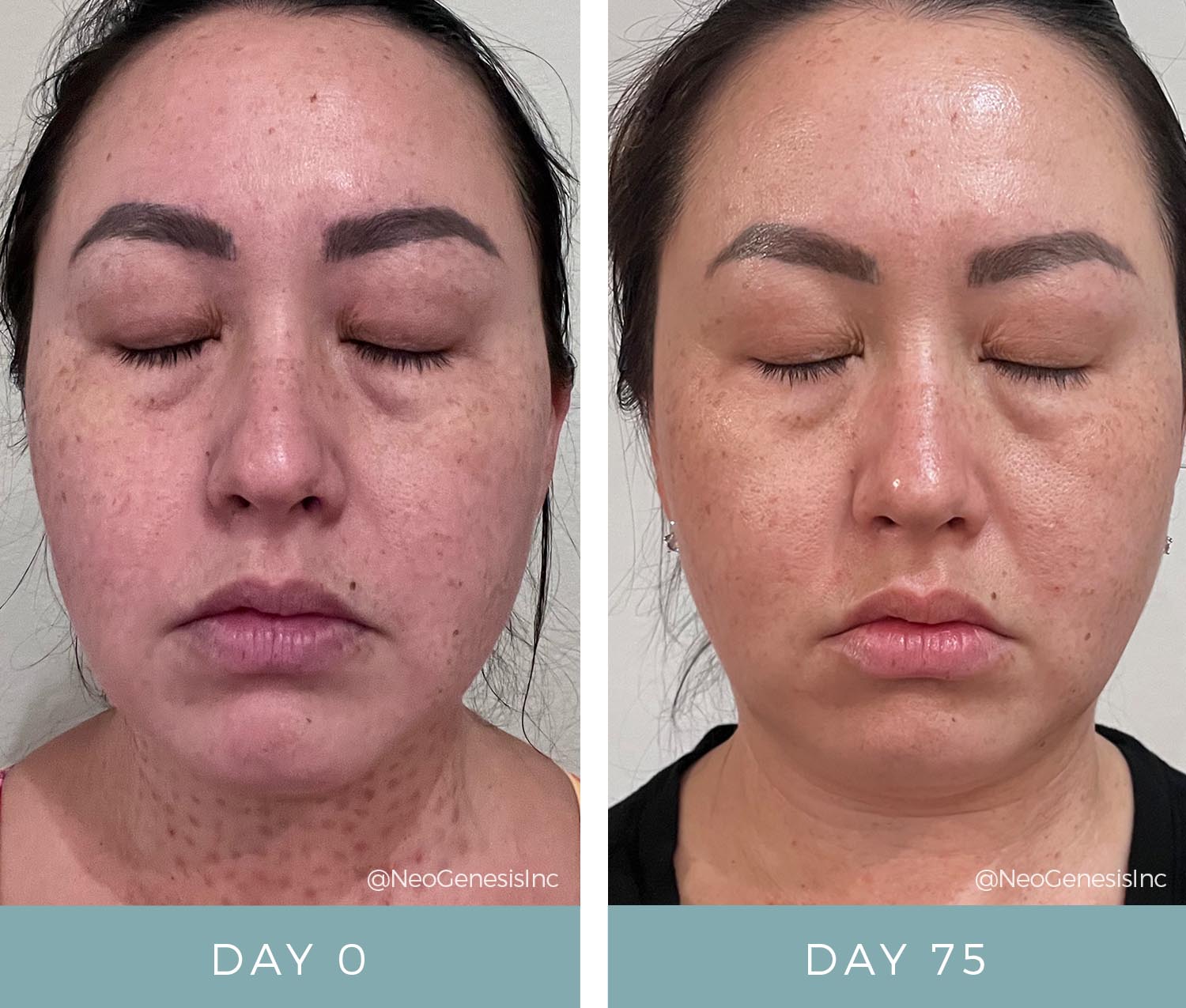 Before + After - Fibroblast Scarring + Ageing Skin + Hyperpigmentation