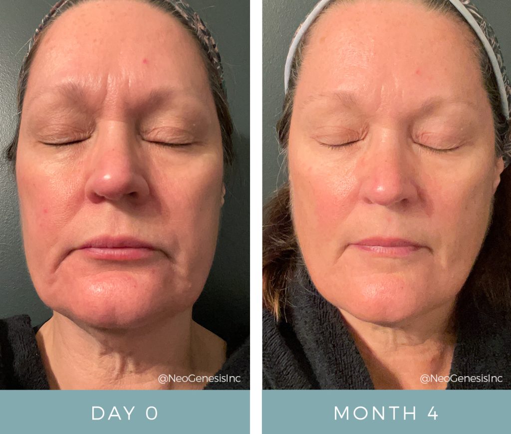 Before+ After - Ageing Skin + Rosacea + Eczema