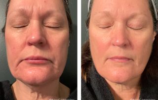 Before+ After - Ageing Skin + Rosacea + Eczema