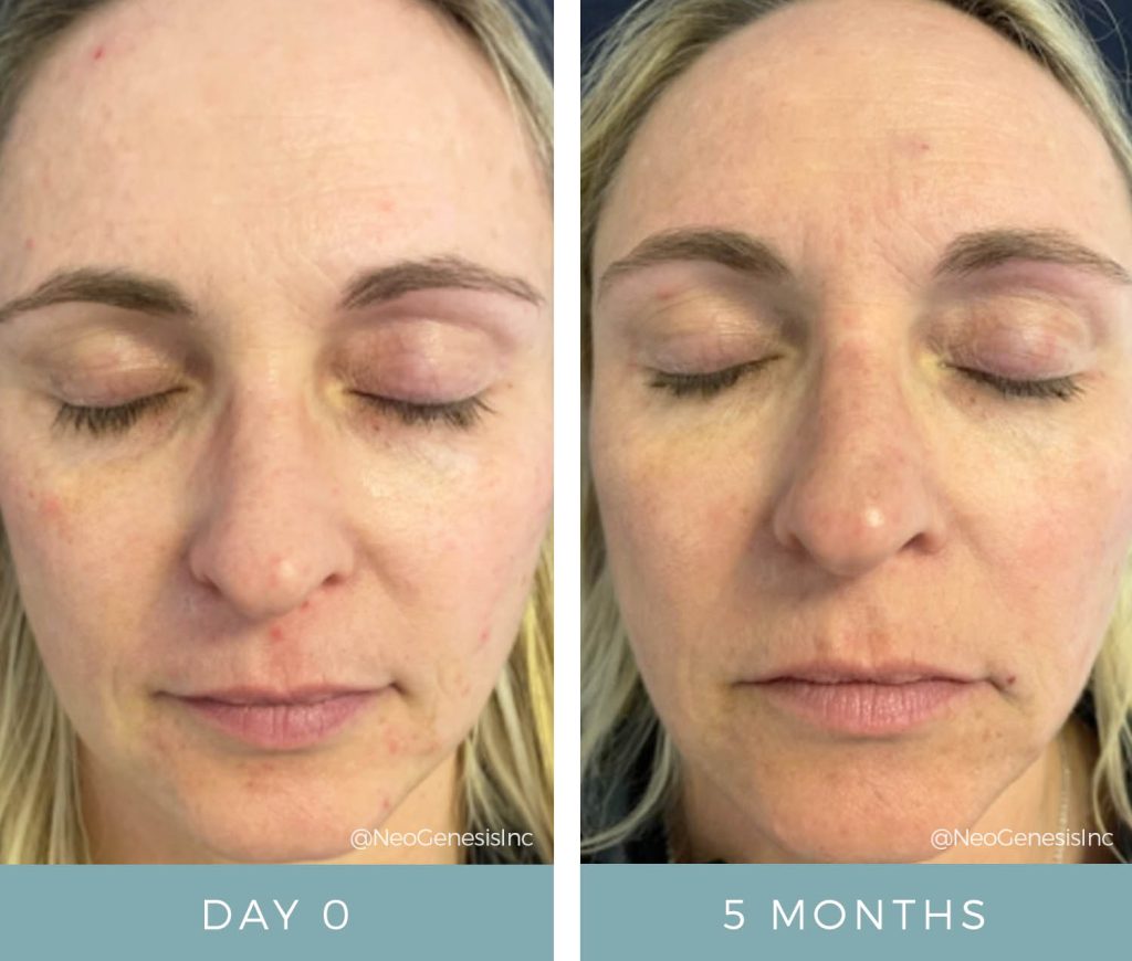 Before + After - Early Signs of Ageing