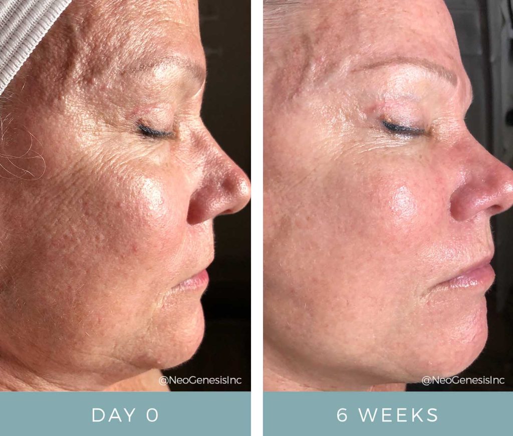 Before + After - Ageing Skin + Sun Damage + Hyperpigmentation