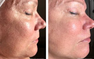 Before + After - Ageing Skin + Sun Damage + Hyperpigmentation