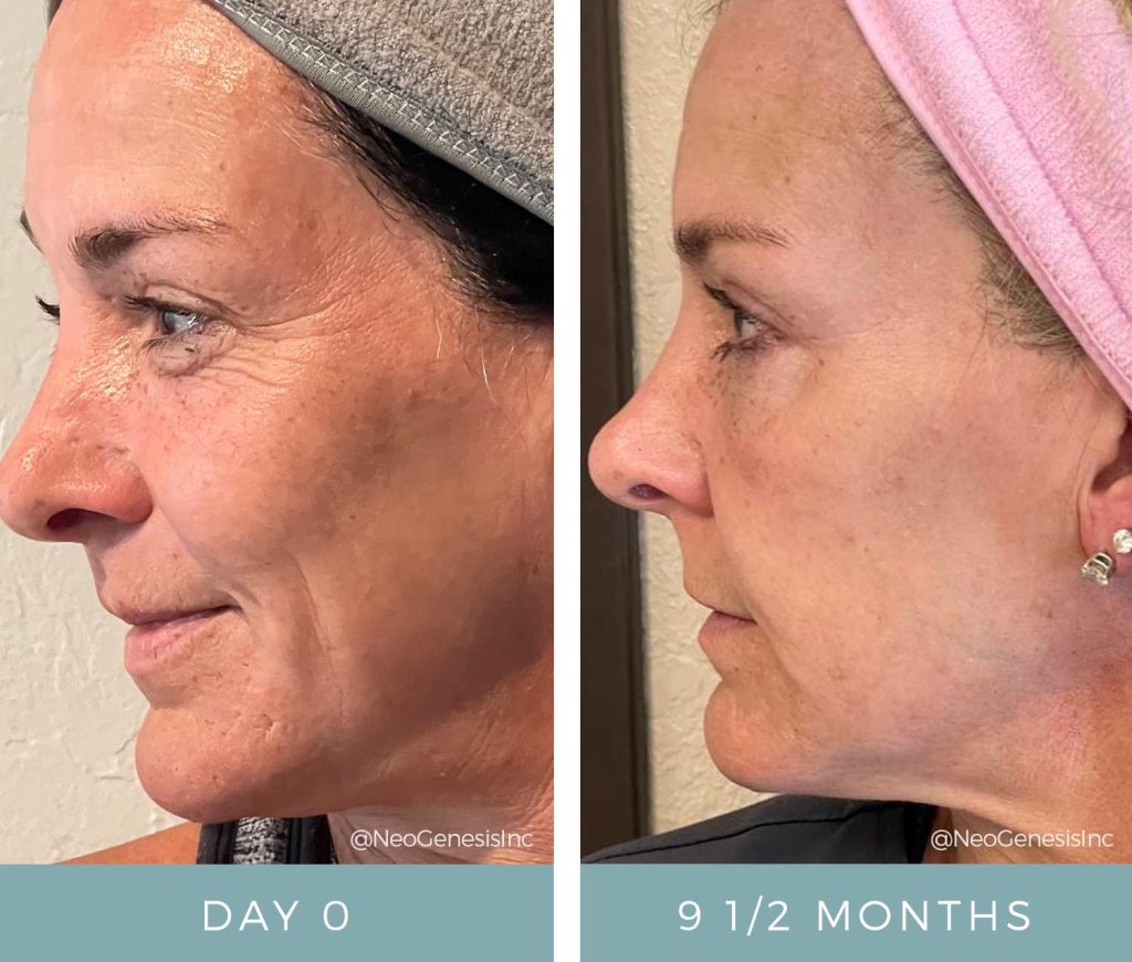 Before + After - Ageing Skin