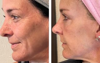 Before + After - Ageing Skin