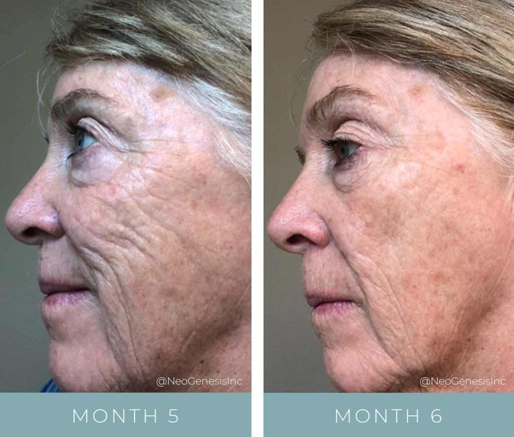 Before + After - Ageing Skin + Sun Damage