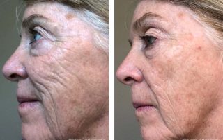 Before + After - Ageing Skin + Sun Damage