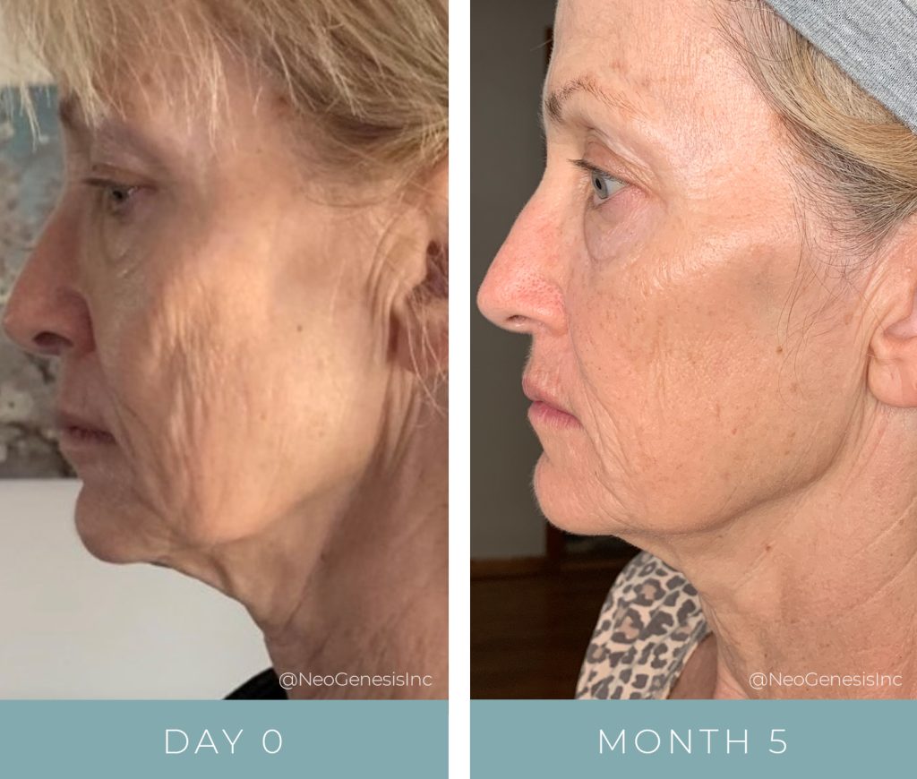 Before + After - Ageing Skin